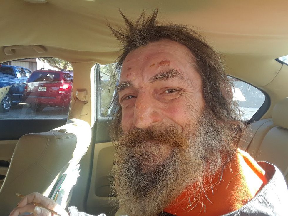 Paul Patchin sustained burns to his face and hair following a fire at his home in February.